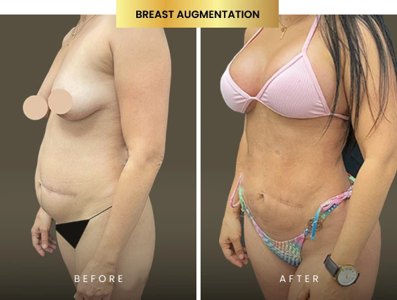 breast augmentation before and after