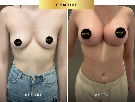 breast lift before after