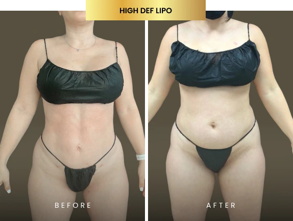 high def lipo before after