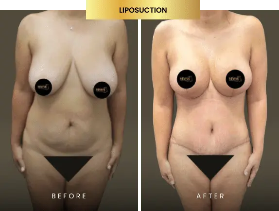 liposuction before after