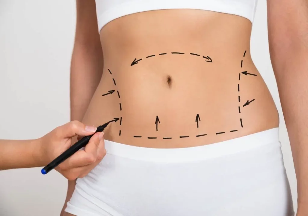 Liposuction J Plasma
