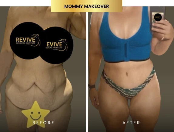 mommy makeover before after