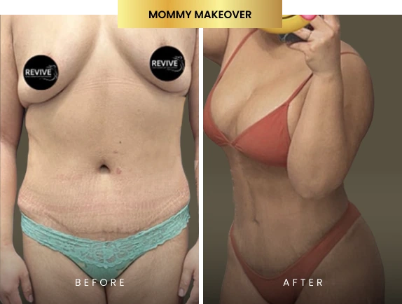 mommy makeover before after gallery banner