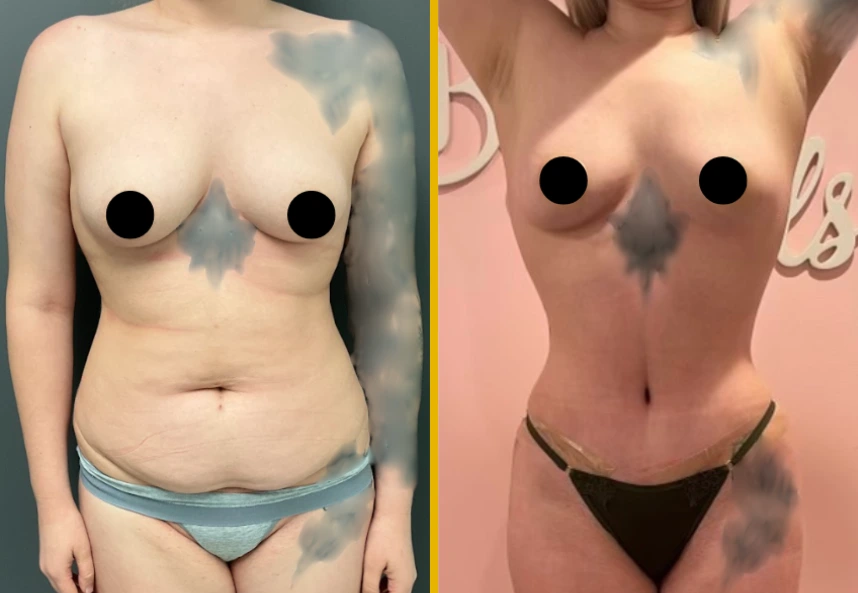 ETT-Back-Lipo-BBL-Back-Jplasma-1