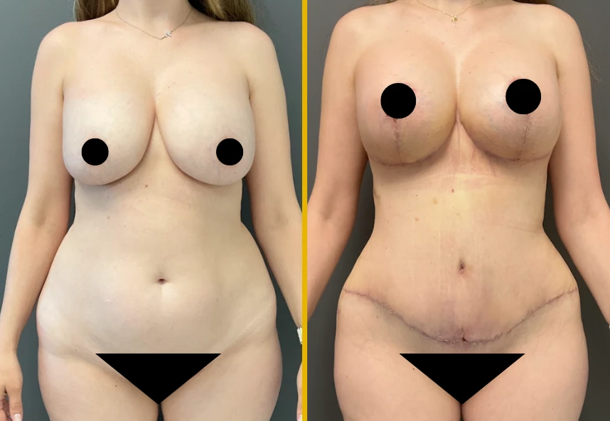 ETT-Back-Lipo-Back-Jplasma-Breast-lift-with-implants-and-Mesh