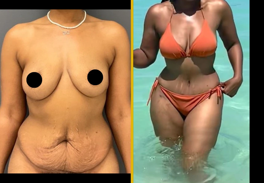 ETT-back-Lipo-Back-J-and-fat-transfer-to-the-breast-1.1