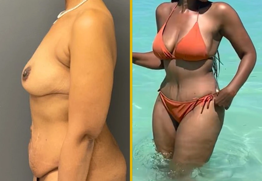 ETT-back-Lipo-Back-J-and-fat-transfer-to-the-breast-1.2