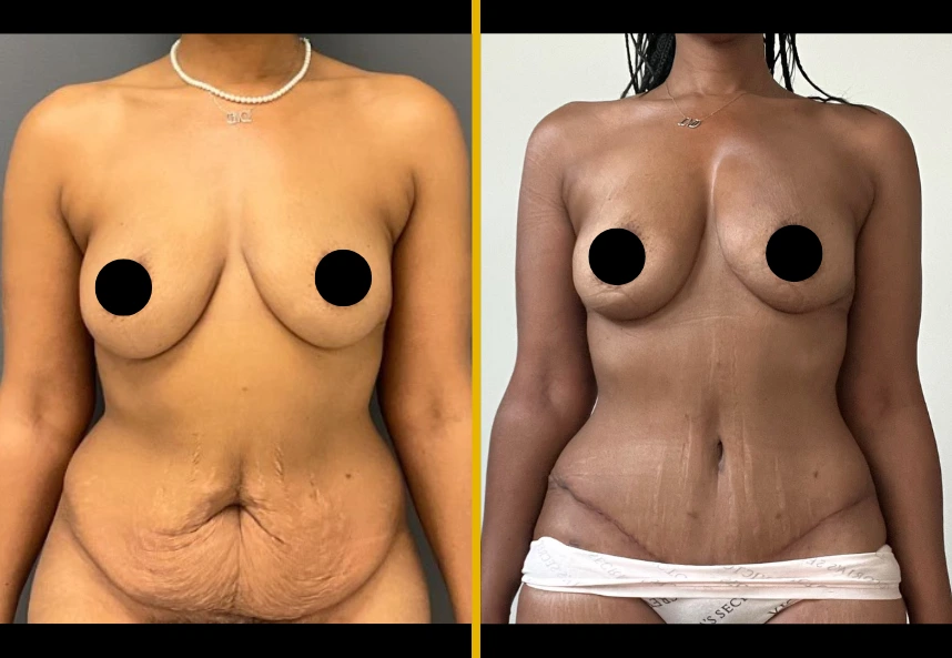 ETT-back-Lipo-Back-J-and-fat-transfer-to-the-breast-1