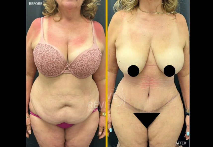 ETT-back-lipo-a