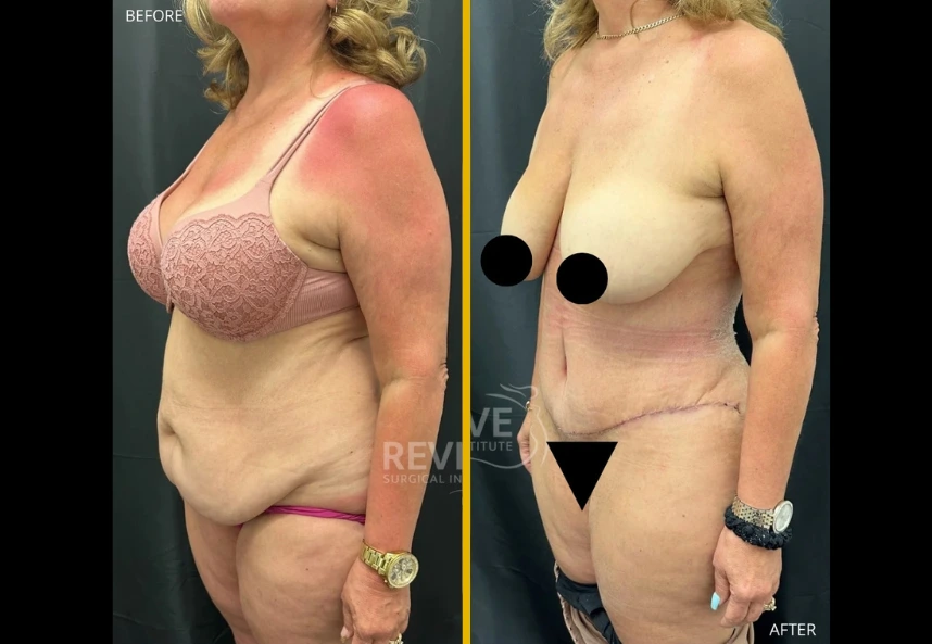 ETT-back-lipo-b