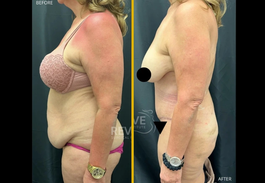 ETT-back-lipo-c