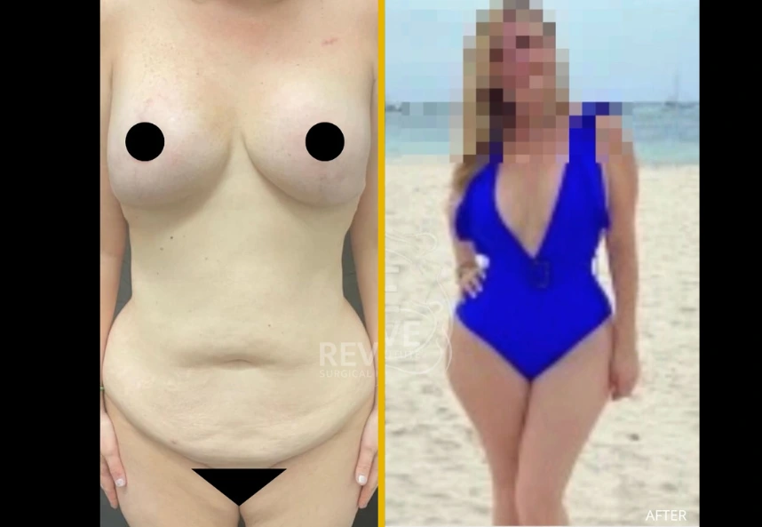 ETT-back-lipo