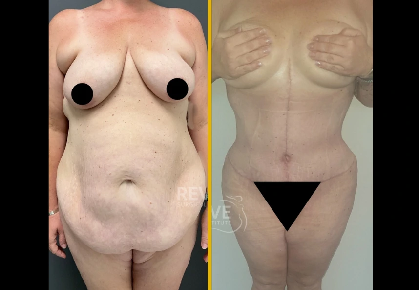 Fleur-de-lis-back-lipo-jplasma-a