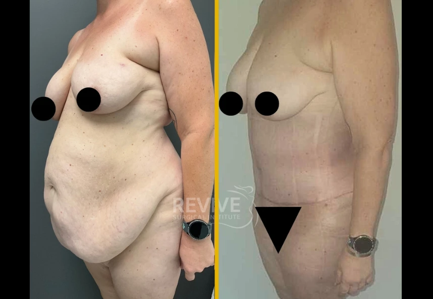 Fleur-de-lis-back-lipo-jplasma-b