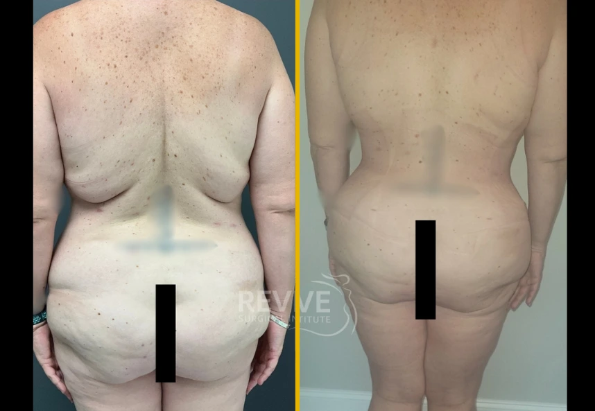 Fleur-de-lis-back-lipo-jplasma-d