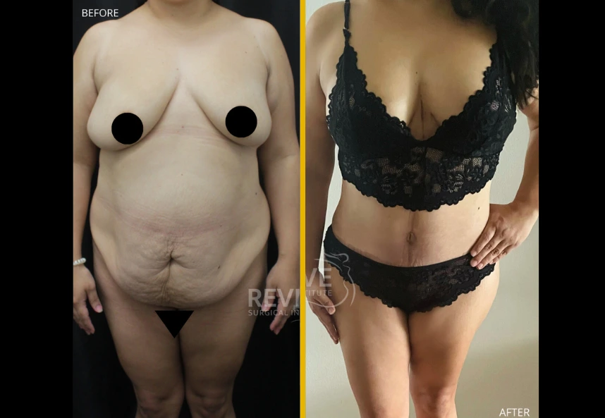 Fleur-de-lis-tummy-tuck-Breast-augmentation-with-lift-Back-Lipo-Jplasma