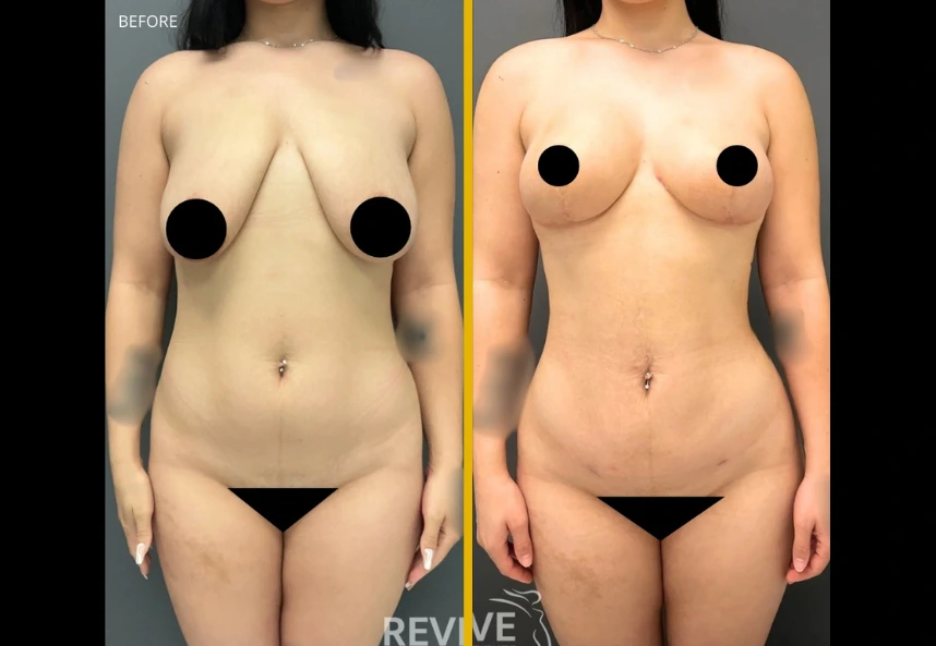 Revive-xlift-and-breast-lift-a