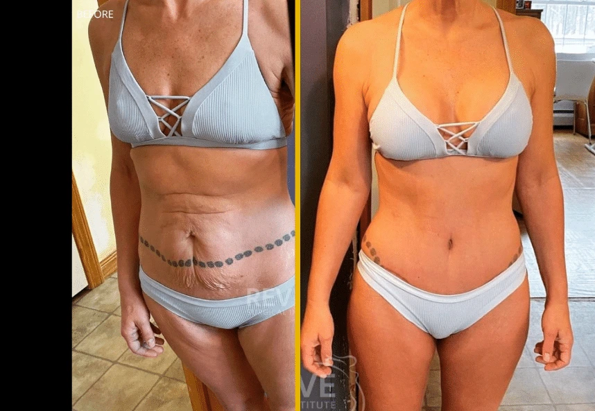 TT-breast-aug-lipo-360-BBL-1