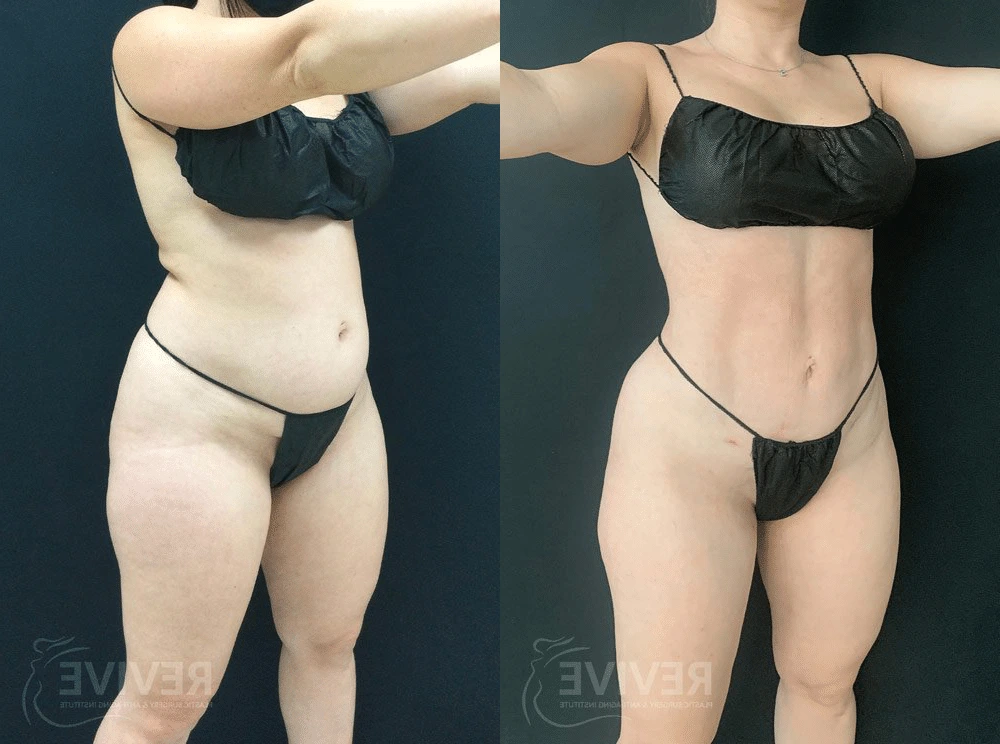 Before and After Gallery: Liposuction