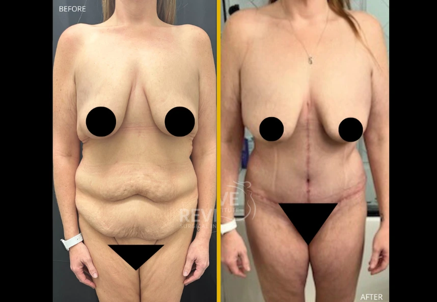 fleur-de-lis-tummy-tuck-back-lipo-and-jplasma