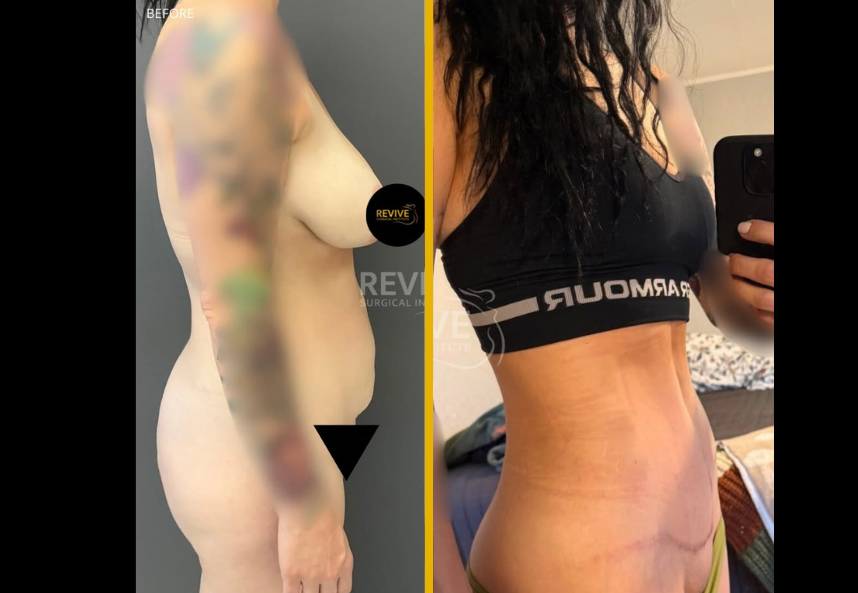 Tummy tuck + Liposuction 1.1
