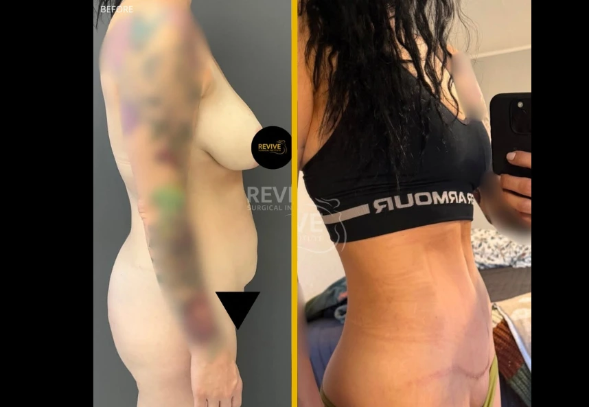 Tummy tuck + Liposuction 1.1