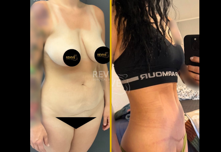 Tummy tuck + Liposuction 1.3