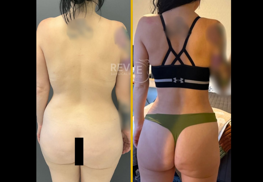 Tummy tuck + Liposuction 1
