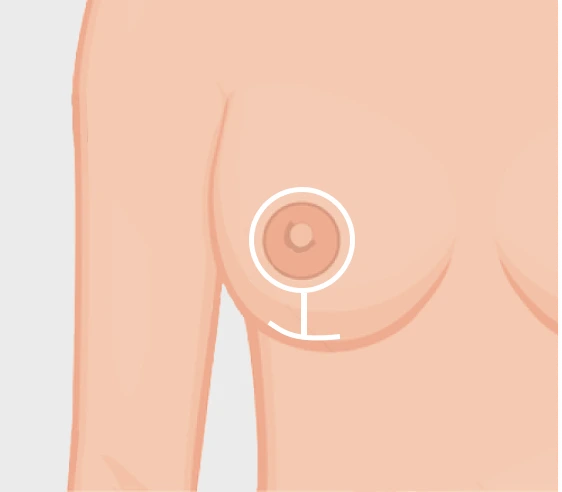 Breast Lift Without Implants Miami FL: Breast Lift Without Breast Implants Incisions Banner