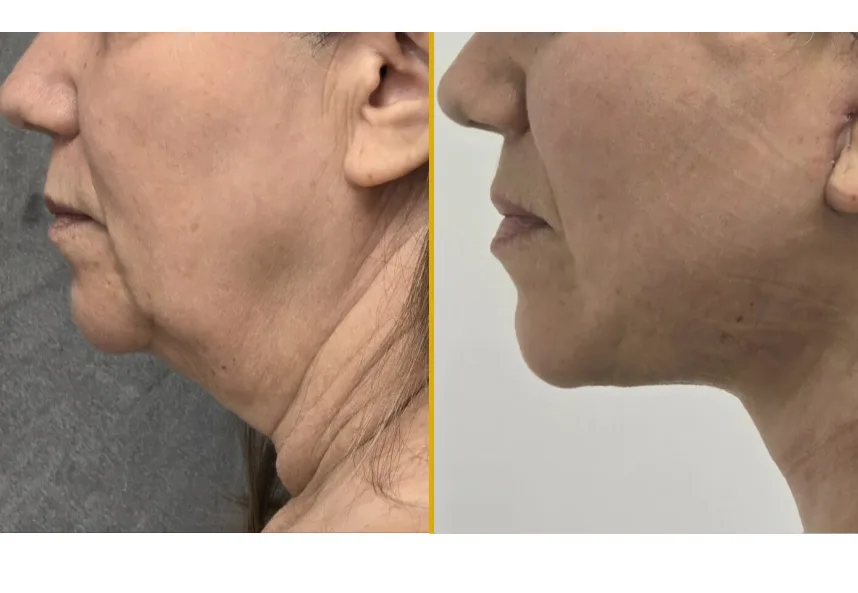 Facelift - Case 1 (3)