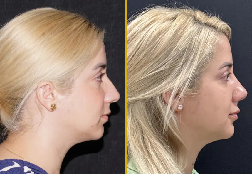 Rhinoplasty - Case 2 (1) (1)