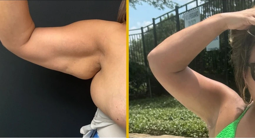 What Is an Arm Lift Surgery? Banner