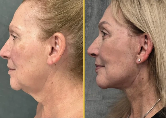 What Is a Facelift? Banner