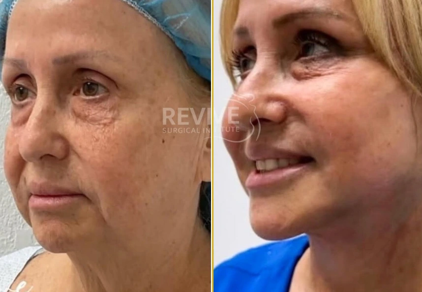 Face Lift 14