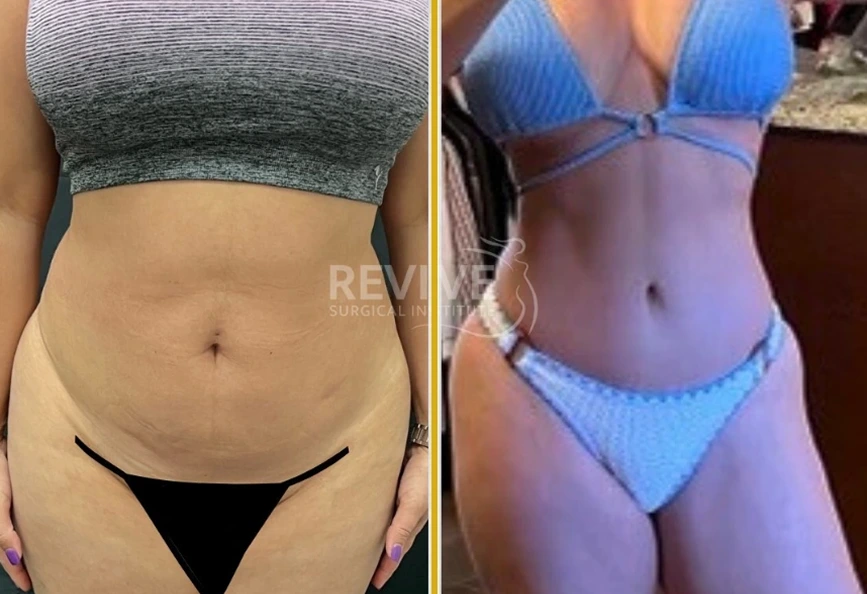 How Body Contouring Works in Miami, FL Banner