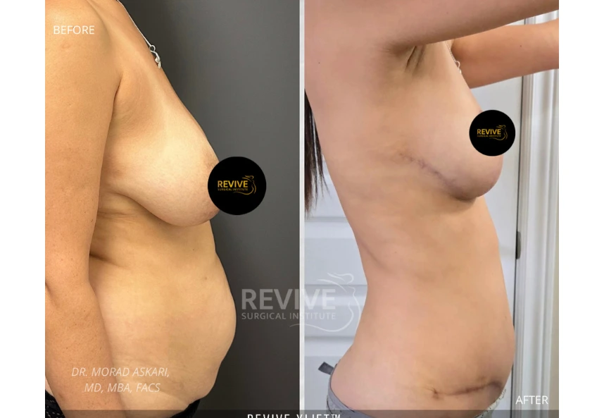 ReviveXlift (4)
