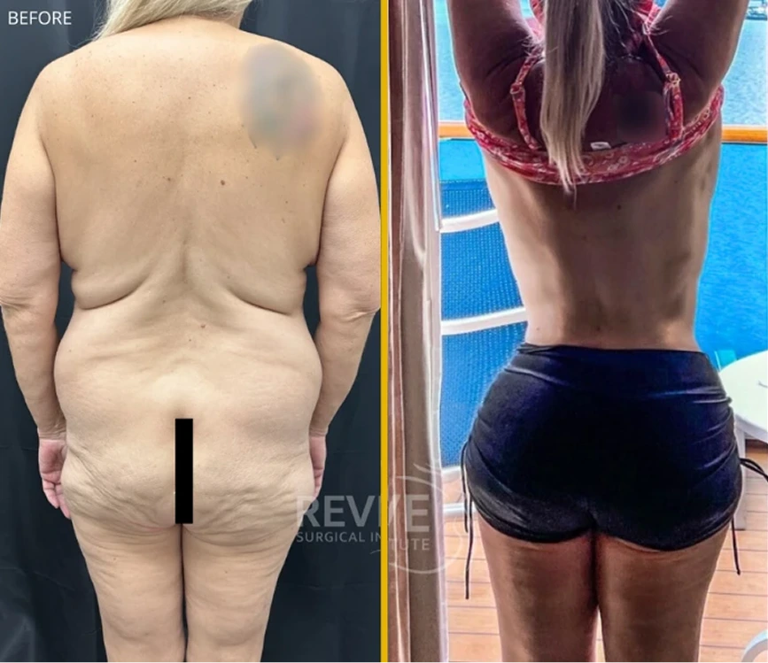 What Is a Lower Body Lift Miami, FL Banner