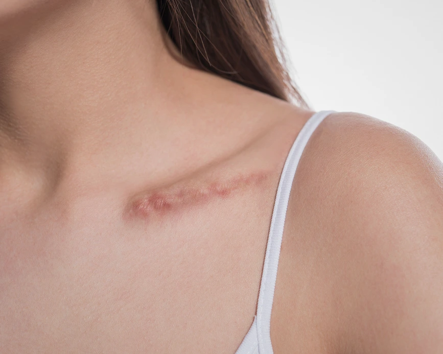 Benefits of Keloid Scar Treatment Miami, Florida Banner