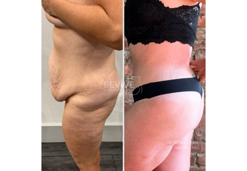 ReviveXlift (3)