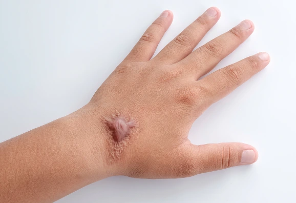 What Is a Keloid Scar Treatment in Miami, FL Banner