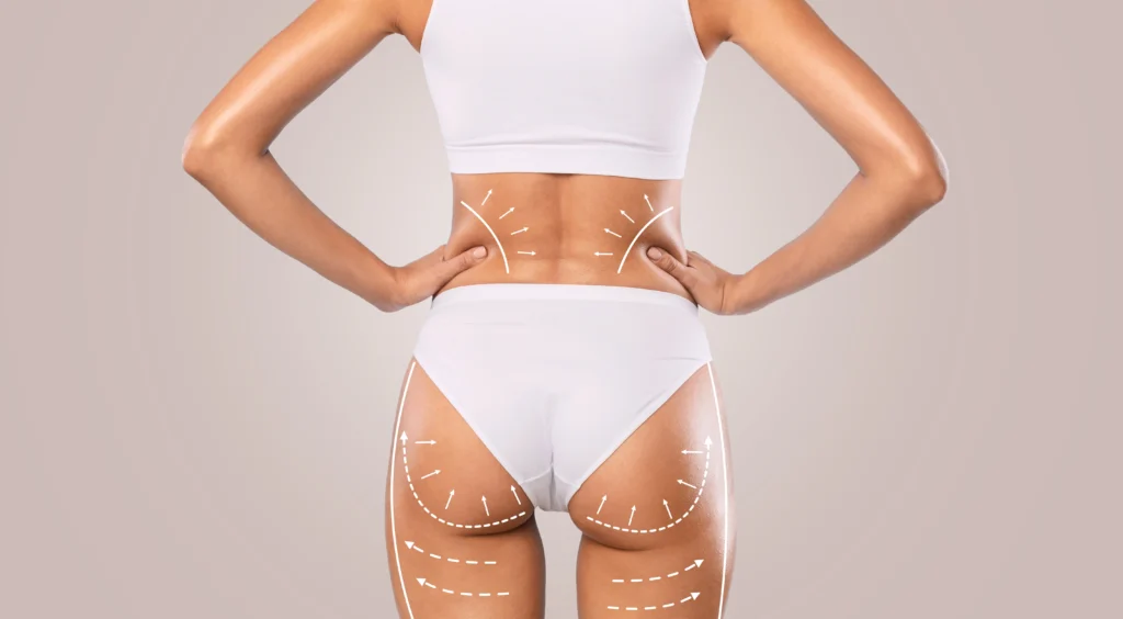 Lipo Without Tummy Tuck: What Kind of Results Can You Expect? Banner