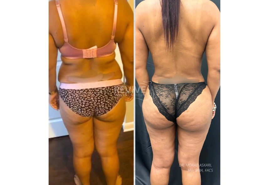 Revive Xlift case 76-1