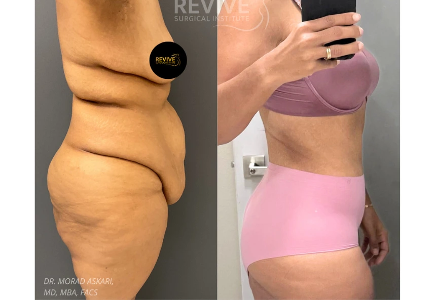 Revive Xlift case 78-2