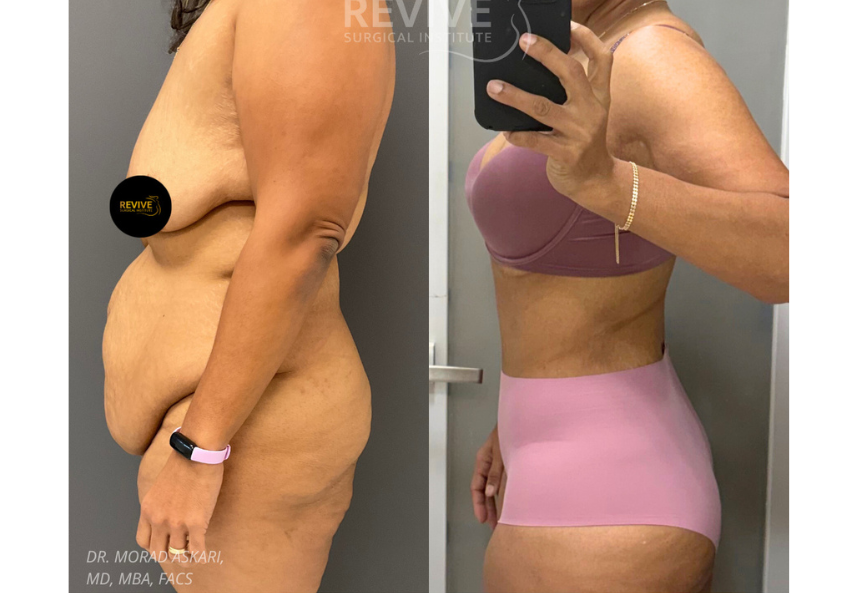 Revive Xlift case 78-3