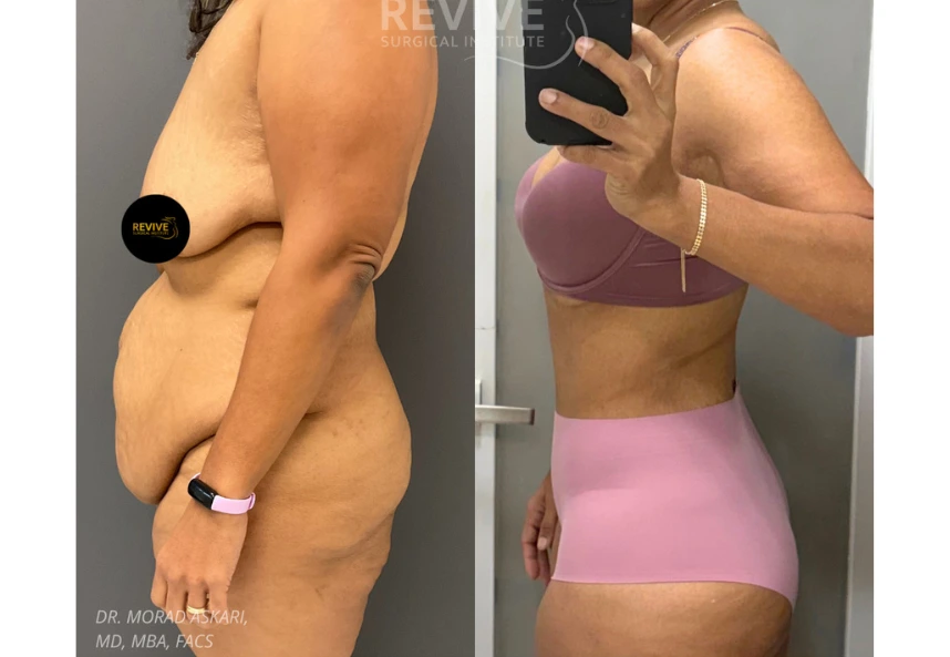 Revive Xlift case 78-3