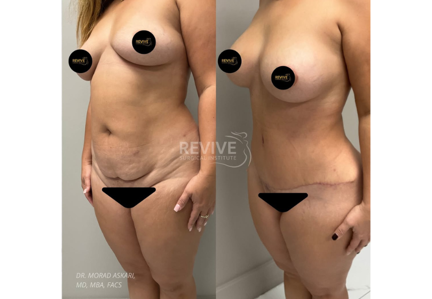 Revive Xlift case 79-2