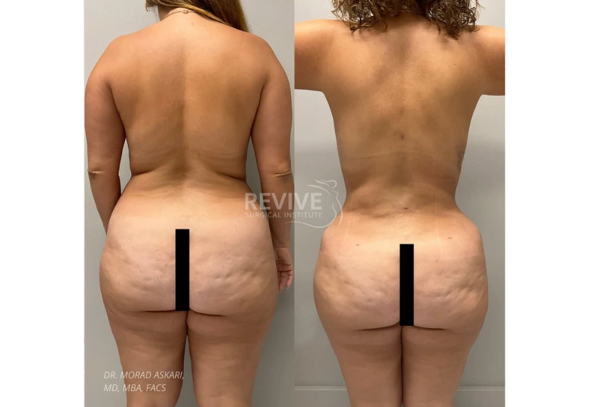 Revive Xlift case 79-3