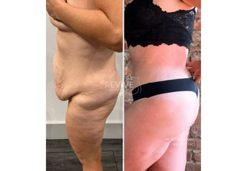 Revive Xlift case 81-2