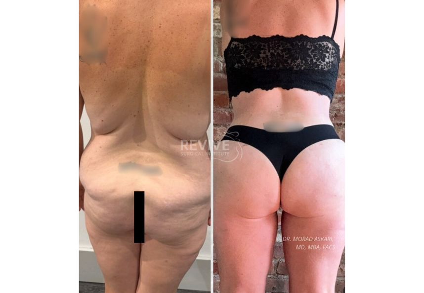 Revive Xlift case 81-3