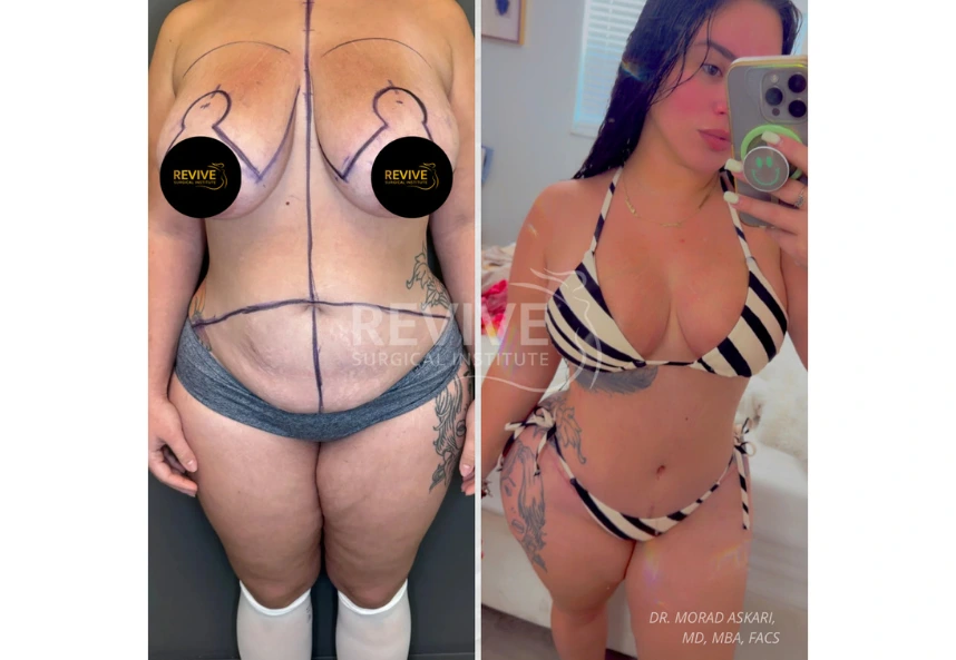 Before and After Gallery: Mommy Makeover